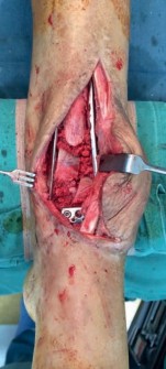 Illustration 33 for Decoding Pilon Fractures: Anterolateral and Medial Fragments Revealed