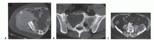 Illustration 5 for Surgical Pelvic Resection: Gluteus Maximus Muscle & Nerve Preservation