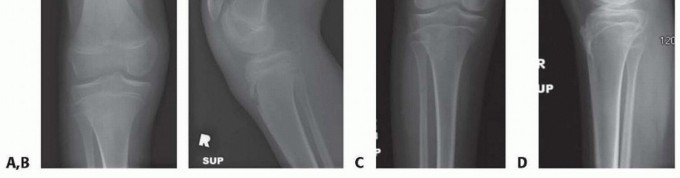 Illustration 8 for Optimizing Growth to Correct Pediatric Limb Deformities