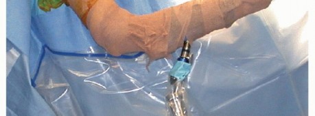 Illustration 10 for Glenoid Bone Graft for Anterior Shoulder Instability: Restore Stability