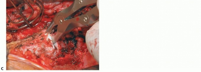 Illustration 31 for Anterior Interbody Arthrodesis for Scoliosis: What You Need to Know
