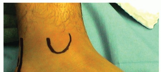 Stop Calcaneal Malunion Pain: Lateral Wall Exostectomy Revealed