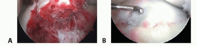 Illustration 14 for Treating Tibial Spine Fractures: Arthroscopy or Open Reduction?