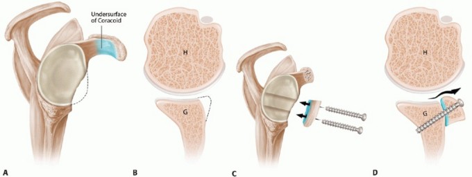 Illustration 6 for Latarjet for Instability: Bone Loss Solutions, Per Burkhart SS, Lo
