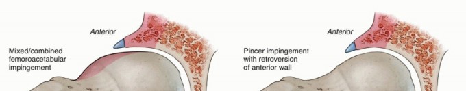 Illustration 7 for Hip Arthroscopy: Your Minimally Invasive Solution for Hip Pain