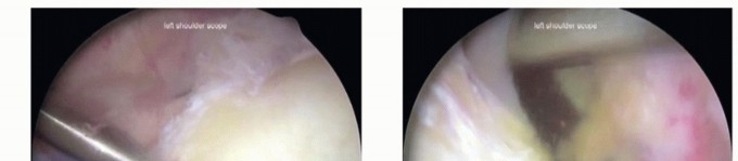 Illustration 12 for Decompressing the Transverse Scapular Ligament for Shoulder Pain Relief