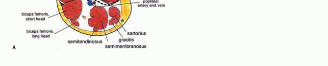 Illustration 24 for Advanced Distal Femoral Resections: Limb-Sparing Outcomes & Techniques