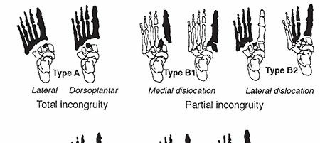 Illustration 22 for Mastering First MTP Joint & Forefoot Fractures: A Comprehensive Guide