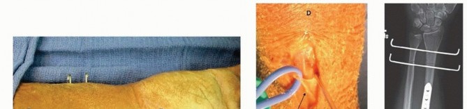 Illustration 11 for Galeazzi DRUJ Stabilization: Unlocking Stability with Smooth Stainless Steel