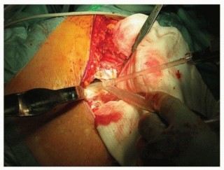 Illustration 24 for Why Polished Tapered Cemented Stems Excel in Hip Replacement