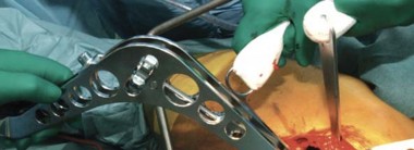 Illustration 57 for Birmingham Hip Resurfacing Designer's Technique for Active Lives