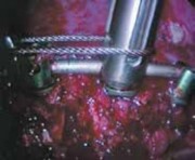 Illustration 26 for Mastering Anterior Interbody Arthrodesis with Instrumentation for Scoliosis