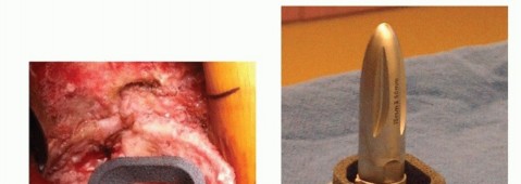 Illustration 4 for Tibial Bone Loss in TKA Revision: Augments for Complex Cases