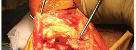 Illustration 44 for Surgical Approaches to Shoulder & Elbow: Pearls and Pitfalls