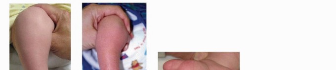 Resistant Clubfoot Solved: Posteromedial and Posterolateral Release