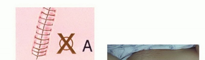 Illustration 41 for Precision Biopsy of Musculoskeletal Tumors for Accurate Diagnosis