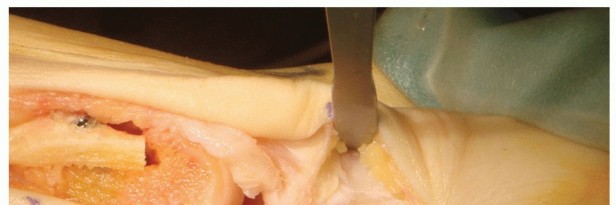 Akin Osteotomy: Unpacking Akin's Role in Hallux Valgus