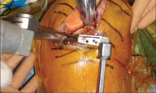 Illustration 9 for Minimal Incision Total Knee: Experience Faster Healing