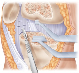 Illustration 42 for Mastering Valgus Total Knee Replacement: Techniques & Pitfalls