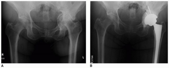 Illustration 13 for Mastering The Uncemented Socket: Ensure Lasting Hip Fixation