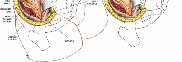 Illustration 23 for Mastering the Posterior Iliac Crest for Bone Graft Harvest