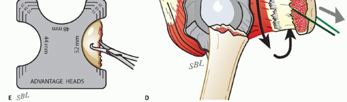 Illustration 17 for Hemiarthroplasty for Proximal: Effective Treatment for Fractures