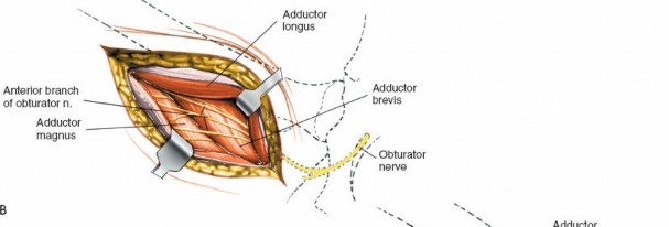 Illustration 218 for Unlocking Every Aspect of the Hip's Surgical Approaches