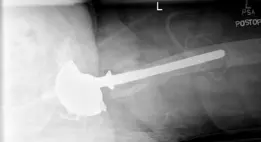 فقدان العظم الشديد ومراجعة استبدال مفصل الورك بمعدن عالي المسامية: حلول متقدمة مع الأستاذ الدكتور محمد هطيف في صنعاء