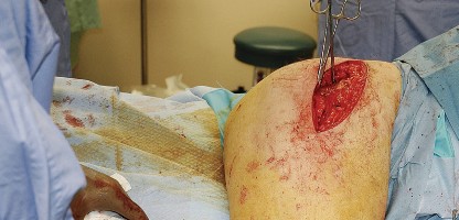 Illustration 58 for Unlock the Figure Posterior Approach to the Hip