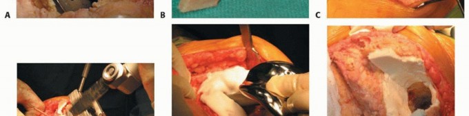 Illustration 15 for Femoral Bone Loss: Metal Augments for Revision Knee Success