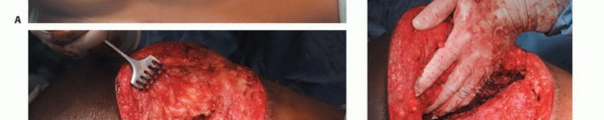 Illustration 27 for Pelvic Metastasis Surgery: A Component of the Utilitarian Approach