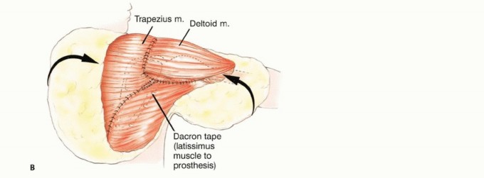 Illustration 16 for Mastering Total Scapular Resections: Reconstruction & Outcomes