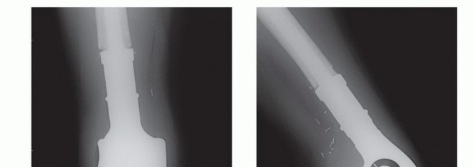 Illustration 48 for Mastering Femoral Metastases: Optimal Function for Femoris & Vastus