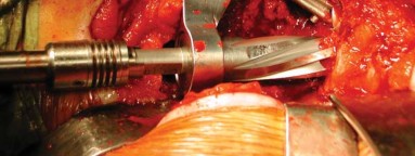 Illustration 19 for S-ROM: Inside the Technique of Modular Implant Design