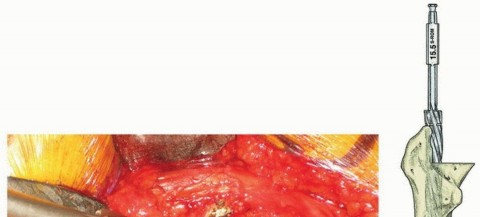 Illustration 14 for Recreate Hip Biomechanics: Modular Stems for Modular Solutions