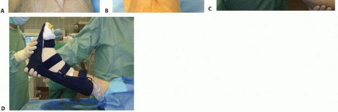 Illustration 32 for HINTEGRA Total Ankle: Unlocking Natural Ankle Movement