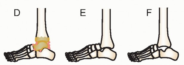 Illustration 2 for Beyond Amputation: Circular Fixation for Infection of the Talus