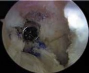 Illustration 12 for Successful Ligament Repair Revision: Fixing Failed ACLs