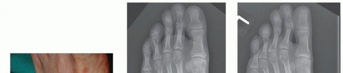 Illustration 73 for Mastering Midfoot Arthrodesis: Protect the Deep Neurovascular Bundle