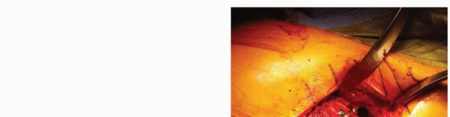 Illustration 14 for The Tapered Stem: Your Guide to Durable Cementless Hip Fixation