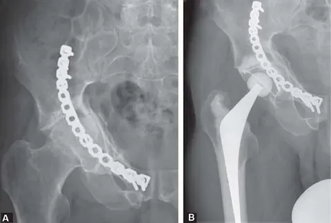 استبدال مفصل الورك المبكر لكسور الحُق: استعادة الحركة والأمل في صنعاء مع الأستاذ الدكتور محمد هطيف