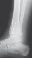 Illustration 19 for Pediatric Ankle Fractures: Management to Prevent Long-Term Issues