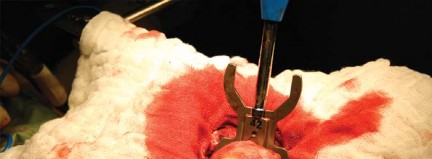 Illustration 55 for Metal on Metal Resurfacing: Enhanced Posterior Soft Tissue Repair