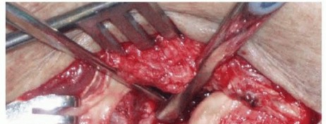 Illustration 16 for Restore Stability & Motion: Fixation of Fracture-Dislocations