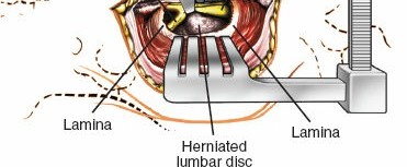 Illustration 4 for Minimally Invasive Posterior Approach: Techniques, Benefits & Recovery
