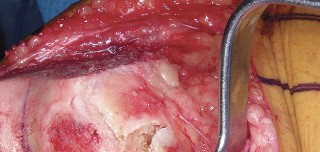 Illustration 49 for Mastering Valgus Total Knee Replacement: Techniques & Pitfalls