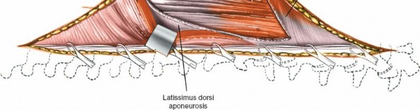 Illustration 402 for Approach to the Lumbar Spine: Mastering Techniques & Anatomy