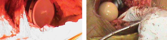 Illustration 43 for Considering METHA Short Stem? Discover Bone-Preserving THA