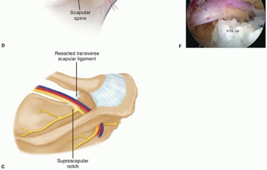Illustration 11 for Decompressing the Transverse Scapular Ligament for Shoulder Pain Relief