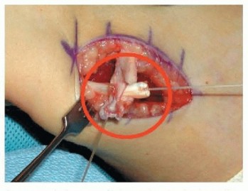 Illustration 10 for Rectus Femoris Muscle Transfer: Restore Gait & Function